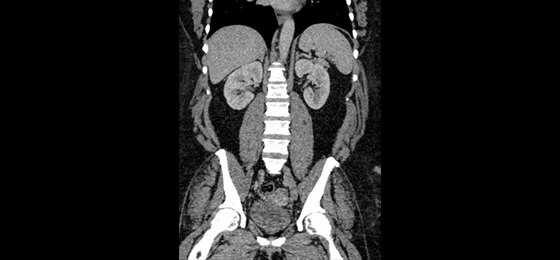 ASiR-V 50% | 0.625 mm