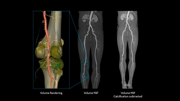 Excellent IQ for peripheral angiography