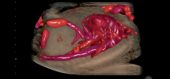 20 week fetal heart with HDlive™ Flow