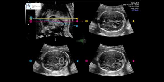 GE Healthcare AI technology helps doctors with critical measurement