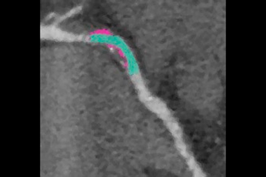 Plaque visualization on RCA on 124 kg male, BMI 40, 57 years old
