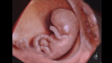 10 week fetus rendered with HDlive™ Studio