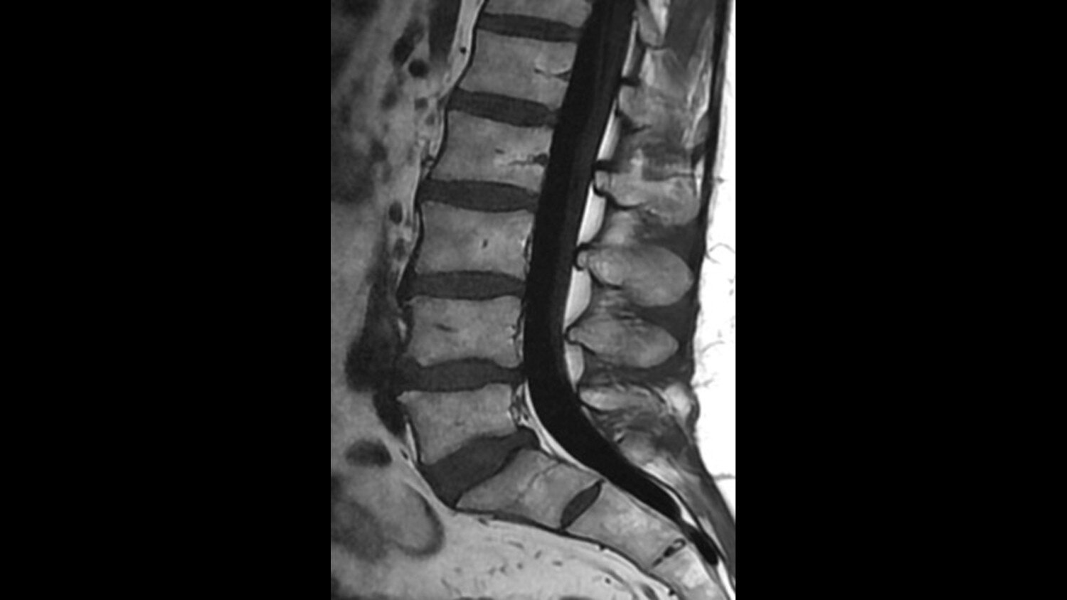 T1 FLAIR Sagittal