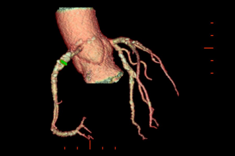 Visualization of the lumen on calcified RCA. BMI 28, HR 57 