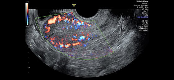 Uterus with HD-Flow™