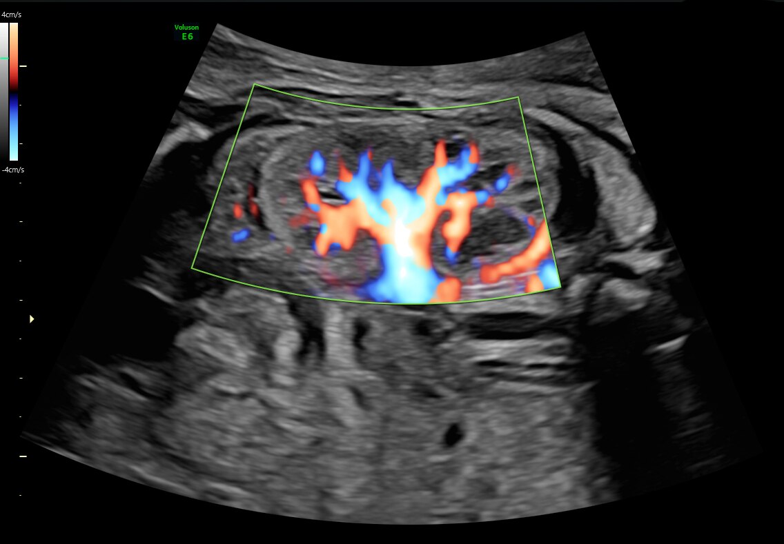 HD-Flow in 27 week fetal kidney