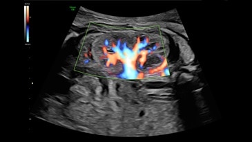 HD-Flow in 27 week fetal kidney