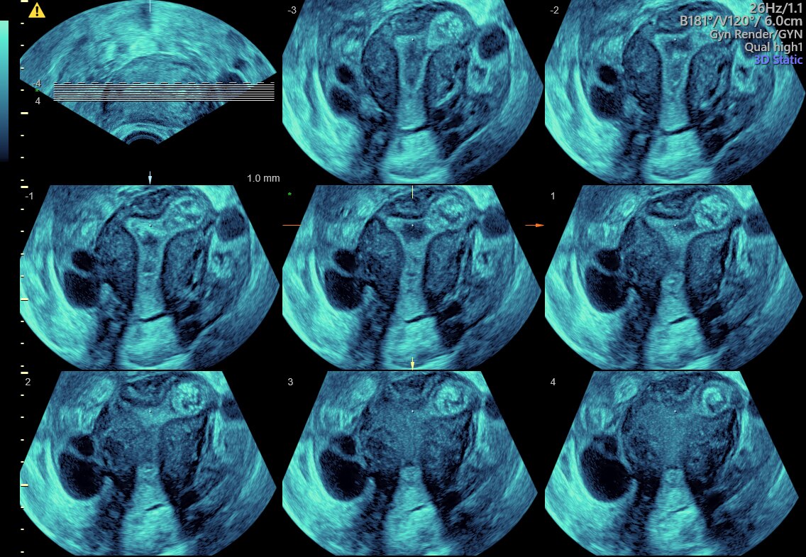 Tomographic ultrasound imaging (TUI) of uterine cavity