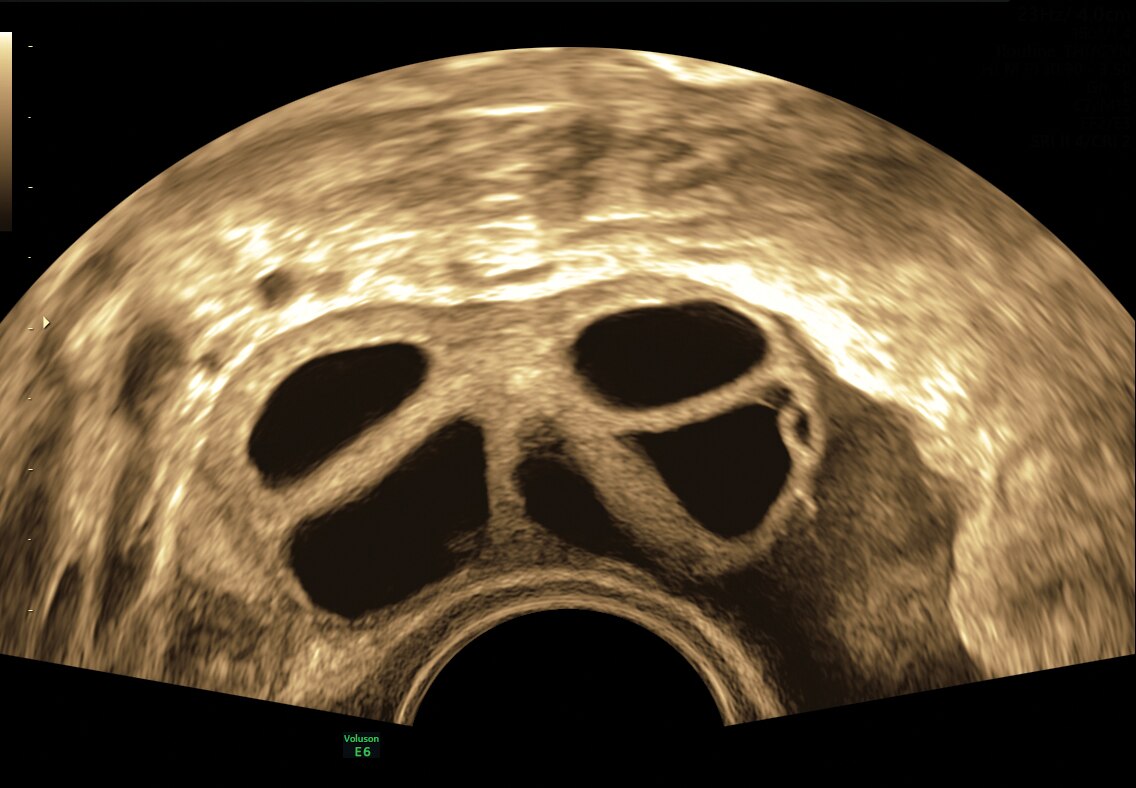 Stimulated ovarian follicles
