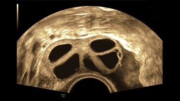 Stimulated ovarian follicles