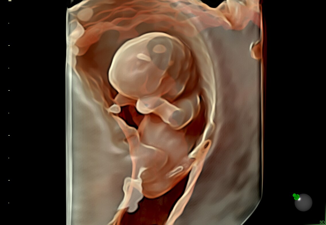 Early brain structures seen with HDlive silhouette
