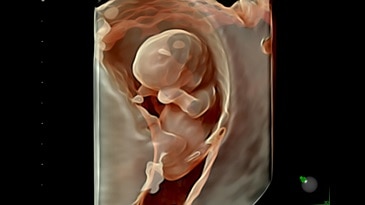 Early brain structures seen with HDlive silhouette