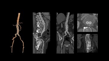 Low-dose abdominal CTA for stent-graft follow Up  