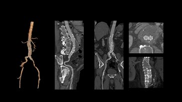 Low-dose abdominal CTA for stent-graft follow Up