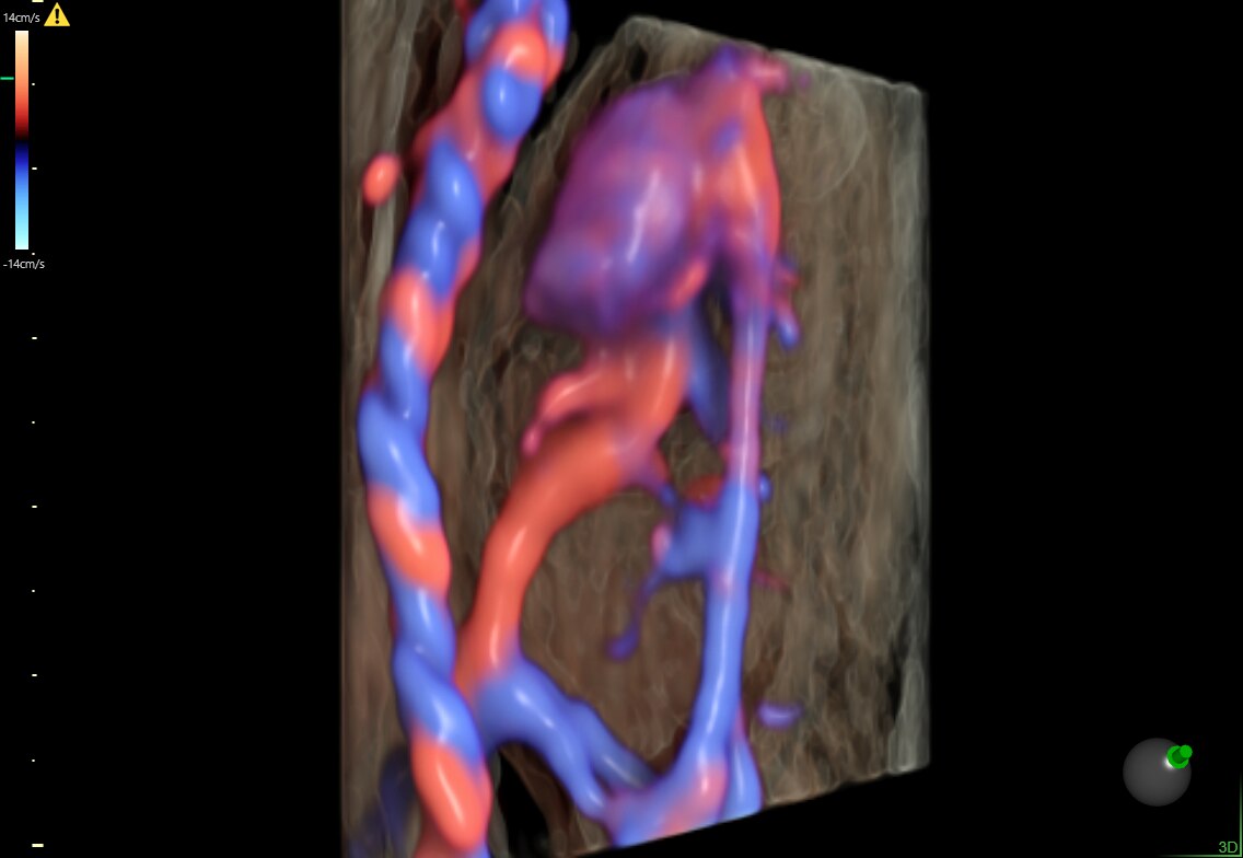 15-week fetal circulatory system with eSTIC and HD-Flow™