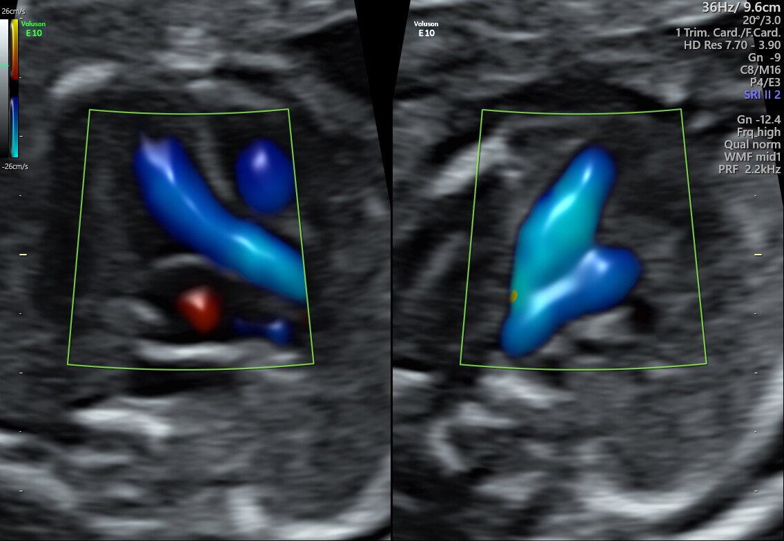 3VV and LVOT with Radiantflow™ in Dual Display