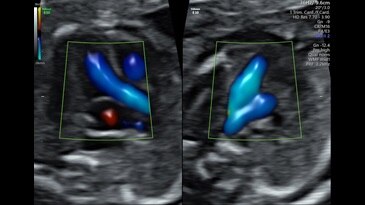 3VV and LVOT with Radiantflow™ in Dual Display