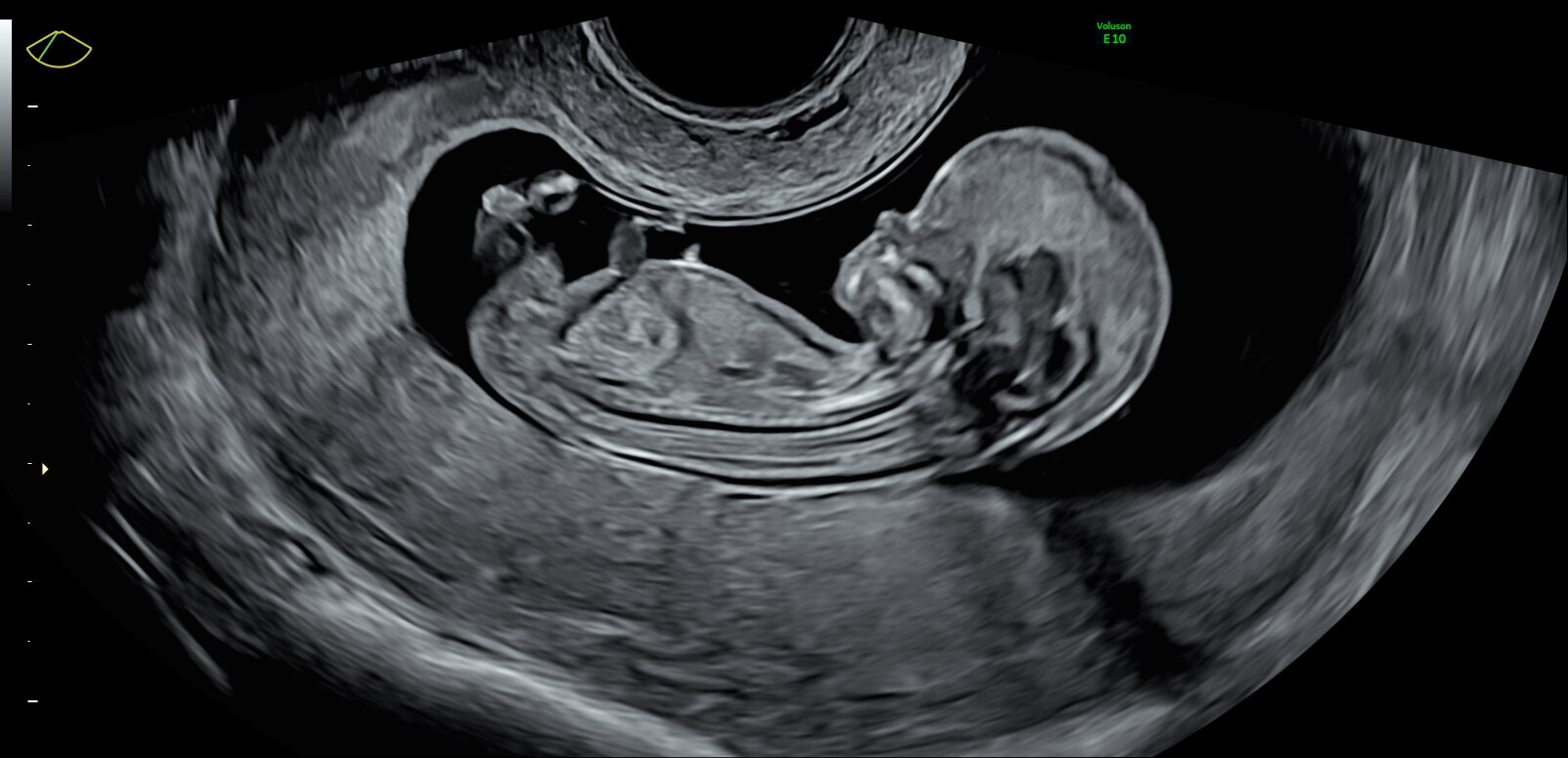 13-week fetal profile