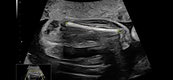 Femur length measured with SonoBiometry