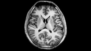 Brain: Silent T1 Axial Reformat
