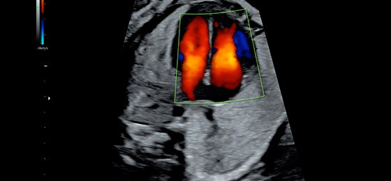 26 week fetal heart