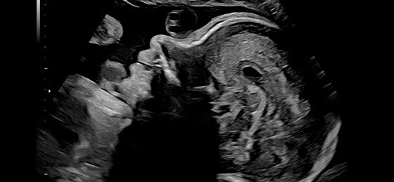 26 week fetal profile