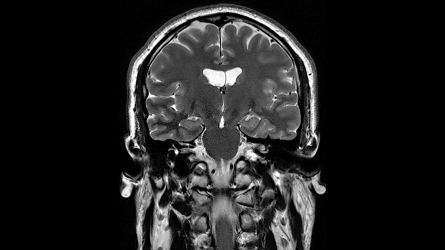T2 PROPELLER Coronal