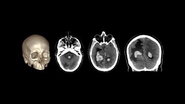 Brain - Bleeding