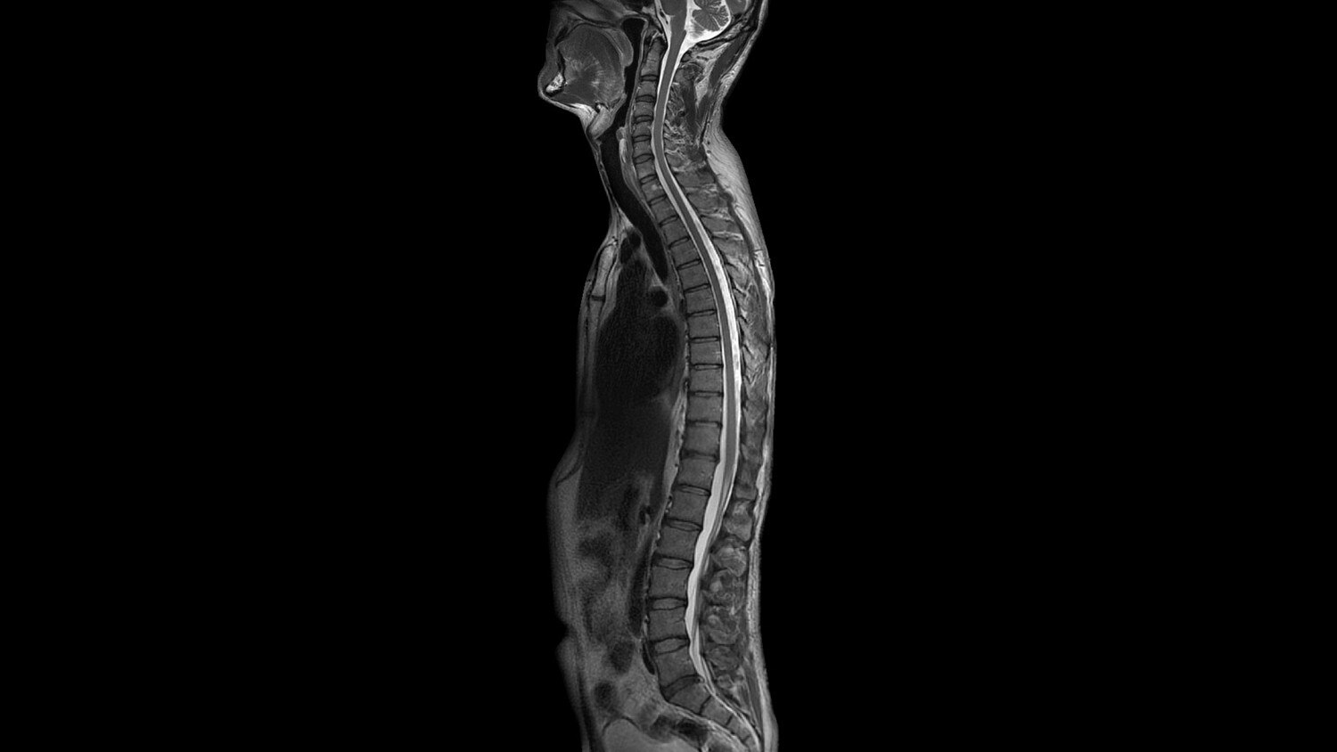 T2 PROPELLER Sagittal