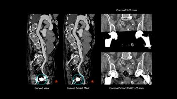 TAVI – iliac vessels assessment (prosthesis) with Smart MAR