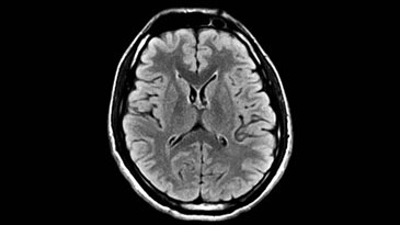 Brain: Silent T2 FLAIR PROPELLER