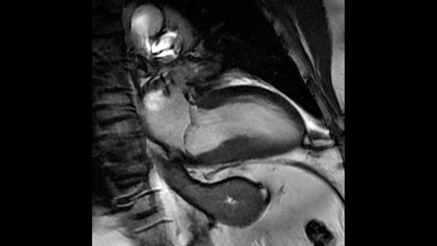 FIESTA Cine Four chamber view