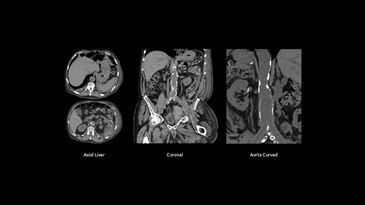 Abdominal Aorta Aneurysm