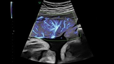 37 week placenta with SlowflowHD
