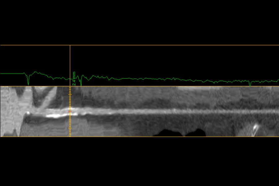 64-year-old male. Atrial Fibrillation. 56-82 BPM, BMI 28