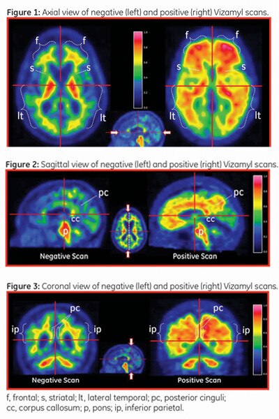 product-product-categories-nuclear-imaging-agents-vizamyl-interpreting-scans-figures.jpg