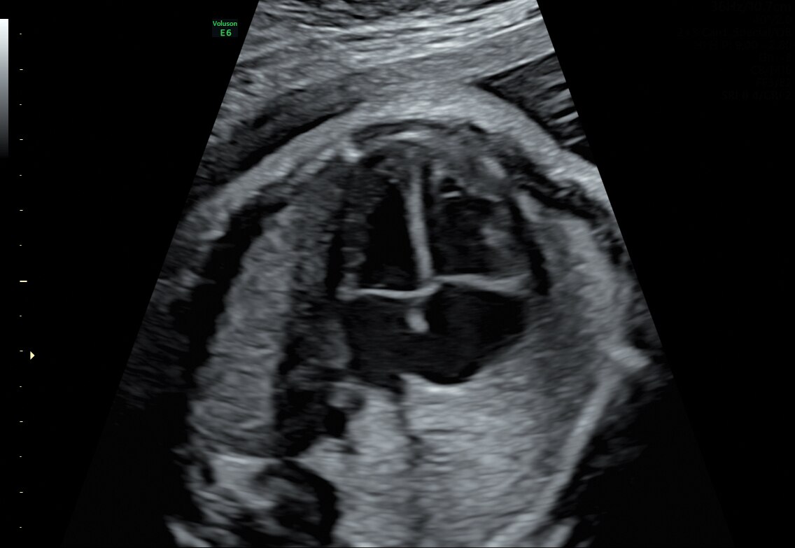 29 week 4 chamber heart