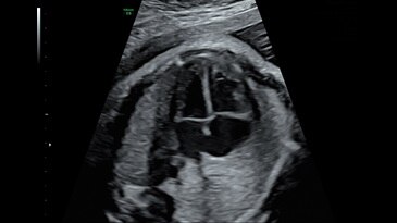 29 week 4 chamber heart