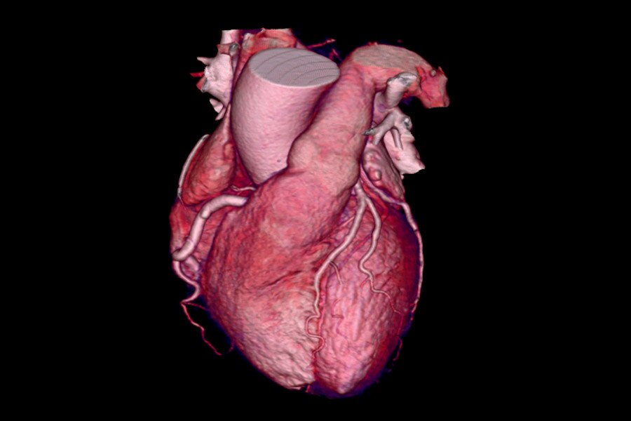 62-year-old female - 62 BPM, BMI 29
