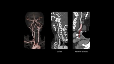 Carotids, Right stenosis