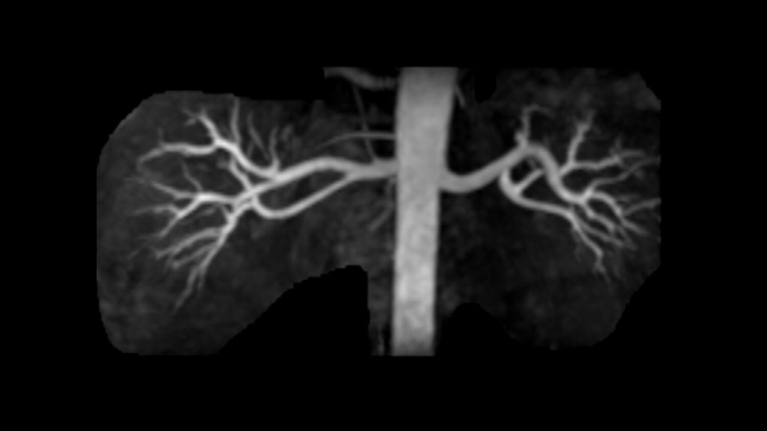 Inhance 3D Inflow IR