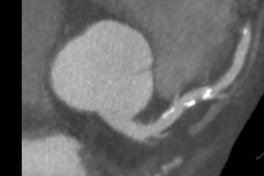 Calcified Plaque on 118 kg patient, 63 BPM, BMI 40.3