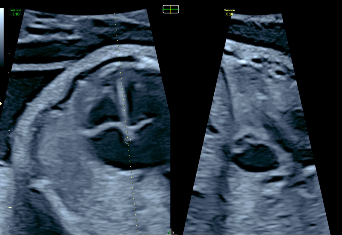 View of intraventricular septum with e4D Bi-plane imaging