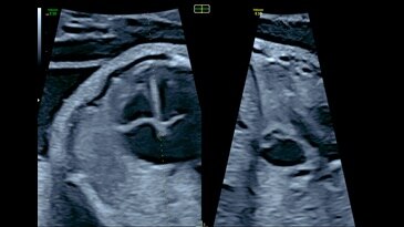 View of intraventricular septum with e4D Bi-plane imaging