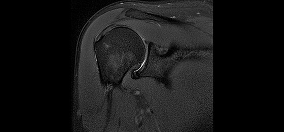 PD PROPELLER Coronal