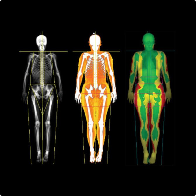 Bone and Metabolic Health Applications | GE HealthCare