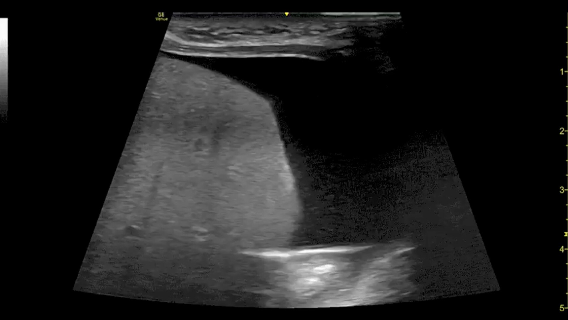 Abdomen-Ascites-L4-20t-desktop