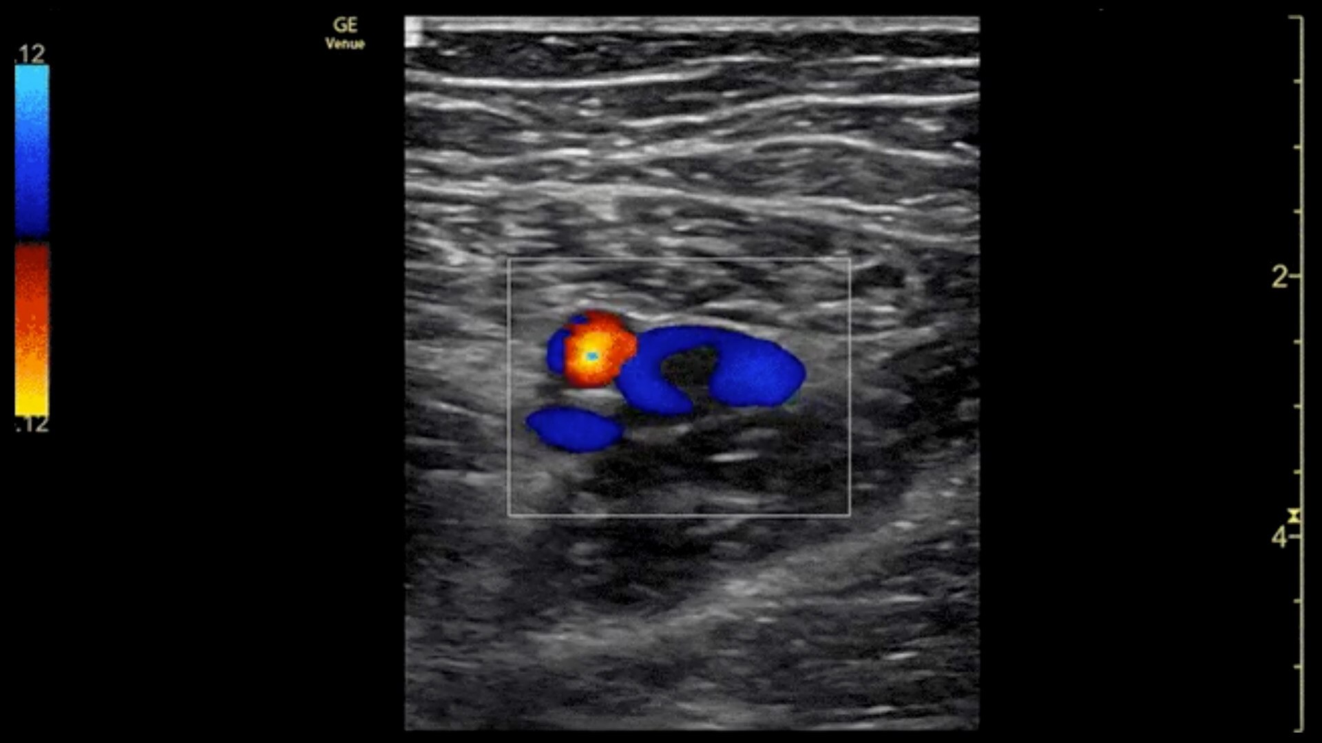 Common-Femoral-Vein-Clot-9L-RS-desktop