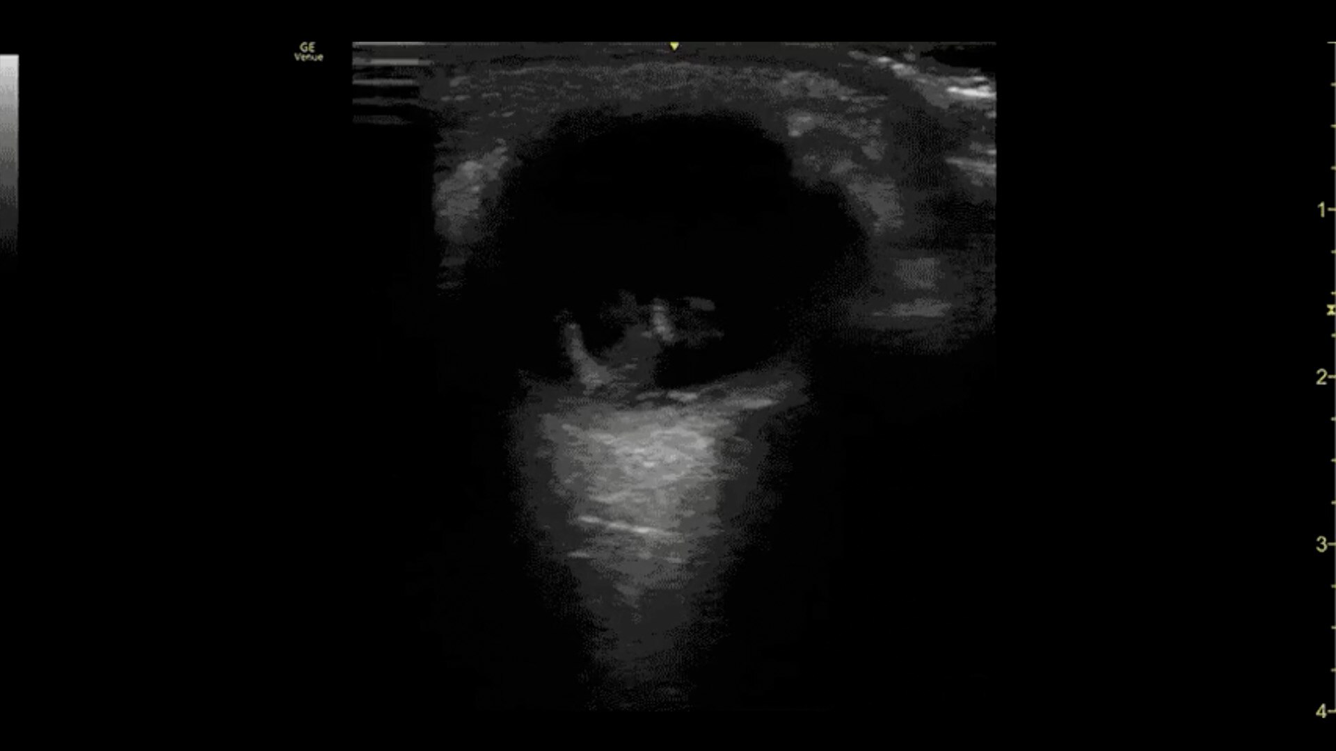 Retinal-Detachment-L4-12t-RS-desktop