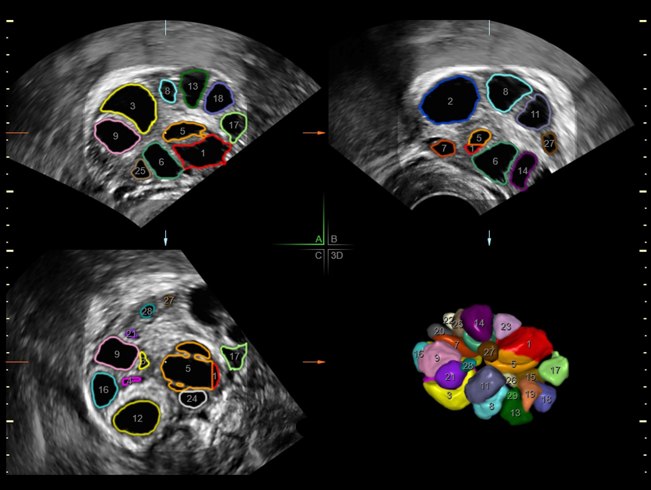 Фолликул SonoAVC™ по технологии GE Healthcare voluson